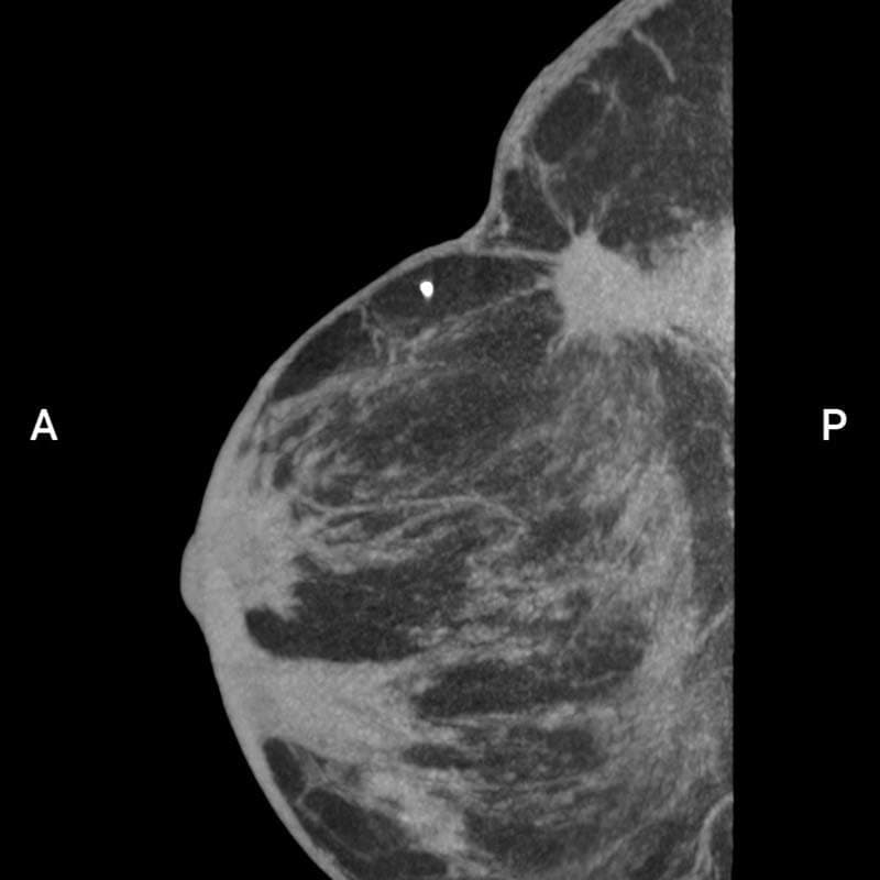 棘状病変（BI-RADS 3）画像