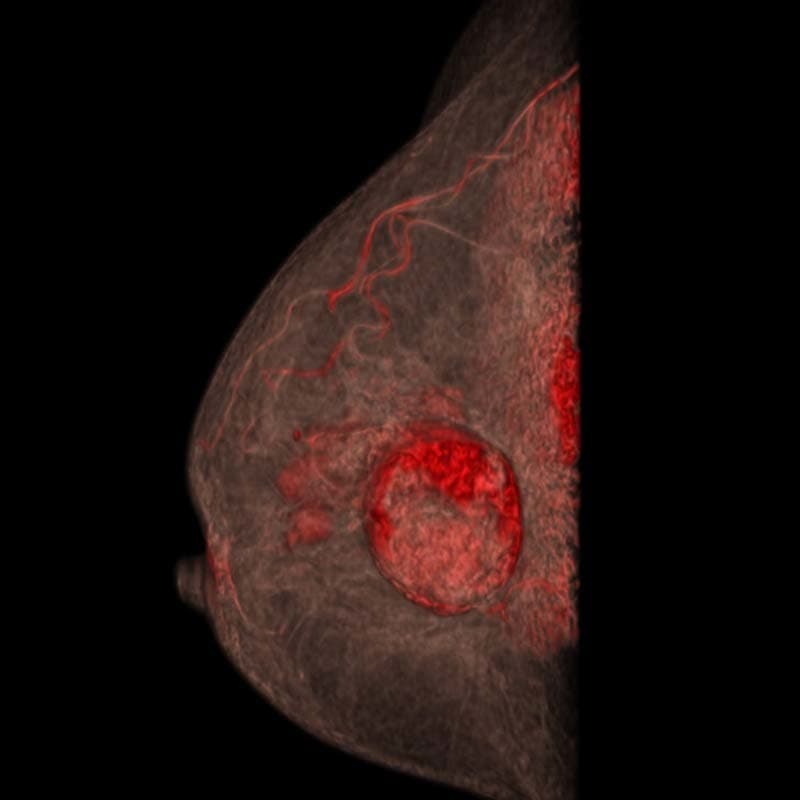 多発性乳がん画像